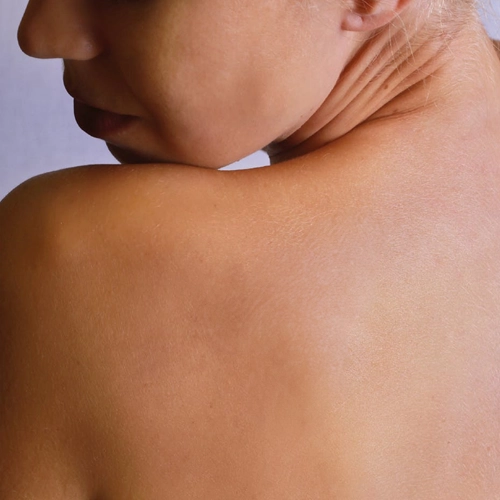 detatouage-laser-avant-apres-22