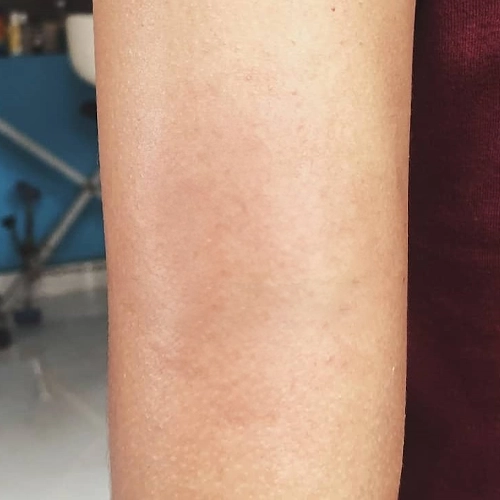 detatouage-laser-avant-apres-32