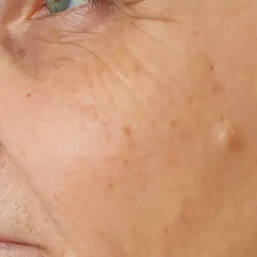 sculptra-5